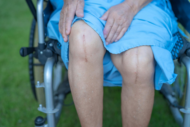 Total Knee Replacement: Restoring Mobility and Quality of Life